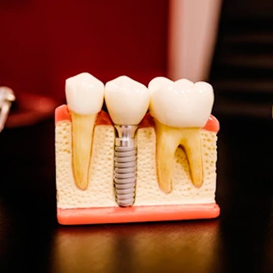 Foto Implantes (Implantodontia) - Dr. Alexandre Esteves